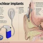 Cochlear Hearing Implants Will Work Directly With iPhone