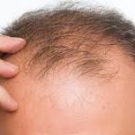 Electric tech could help reverse baldness